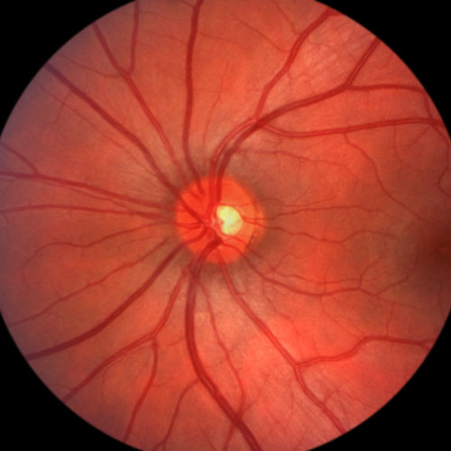 RETINA DISEASE